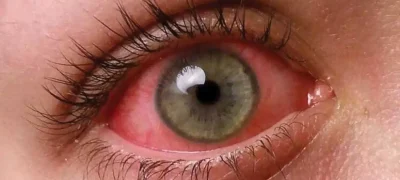 Lahore Faces Alarming Spike in Contagious Pink-Eye Cases