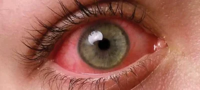 Airport and Airline Guidelines for Pink Eye Infection