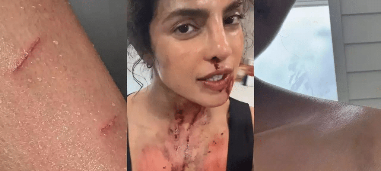 Priyanka Chopra Video Showing Her Behind-The-Scenes Injury Has Gone Viral