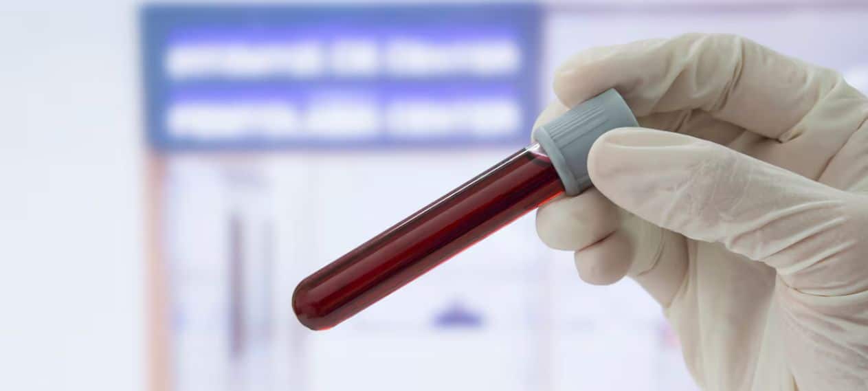 Study Reveals That a Blood Test For Alzheimer's Detects 90% Of Early Dementia Cases