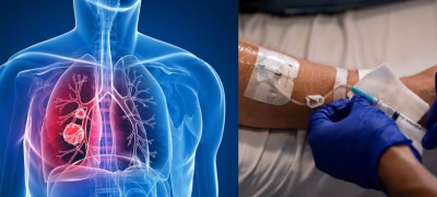 World's First Lung Cancer Vaccine Enters For Clinical Trials