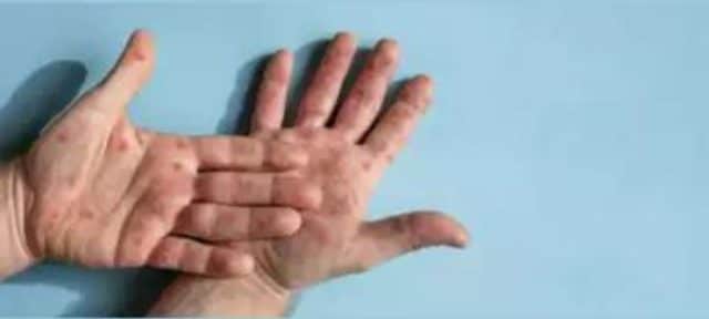 Monkeypox Cases in Pakistan have Increased to Three