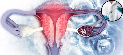 UK Develops World's First Ovarian Cancer Vaccine, Aiming to Eliminate the Disease