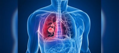 US Approves AstraZeneca and Daiichi Sankyo’s New Lung Cancer Therapy