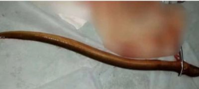 man with eel in abdomen