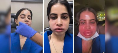 Urfi Javed Removes Lip Fillers After 9 Years, Shares Swollen Face Photos