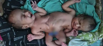 Baby Born with Two Heads, Four Arms Shocks World in Rare Birth