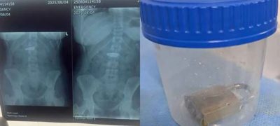 Doctors at Lyari Hospital Remove Metal Lock from Woman’s Stomach Without Surgery