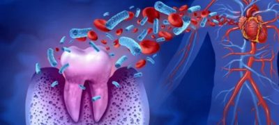 Oral Bacteria Raise Risk of Heart Disease, Study Finds