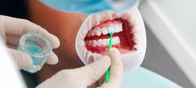 Illegal Teeth-Whitening: The Smile Scam Exposed!