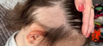 Mother Blames Temu After Toddlerβs Hair Torn Out by Electric Cleaning Brush