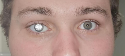 A man replaces eye with 2-carat diamond after losing it in an accident, sparking global debate over luxury, health, and body modification.