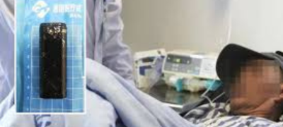 Doctors Remove lighter Found in Patient’s Stomach After 30 Years