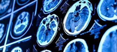 Brain Drainage Blockages May Signal Early Alzheimer’s Risk, Scientists Say
