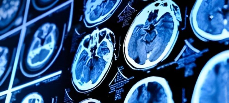 Brain Drainage Blockages May Signal Early Alzheimer’s Risk, Scientists Say