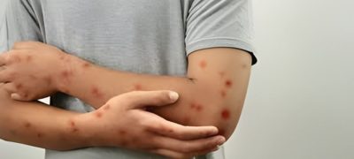 Monkeypox Outbreak in Khairpur Claims Lives of Children, Emergency Measures Imposed