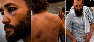 Flotilla Activists Reveal through their own wounds What Palestinians Face in Isr@eli Custody without any media presence