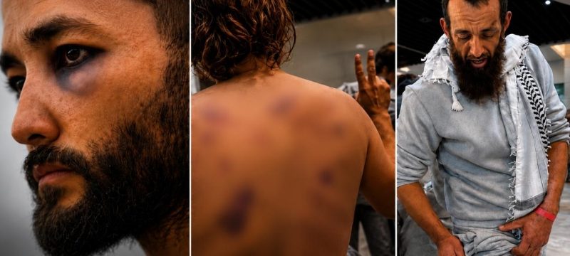 Flotilla Activists Reveal through their own wounds What Palestinians Face in Isr@eli Custody without any media presence