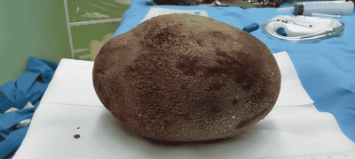 Doctors Remove 1.3kg Bladder Stone After Man Endures Years of Silent Pain
