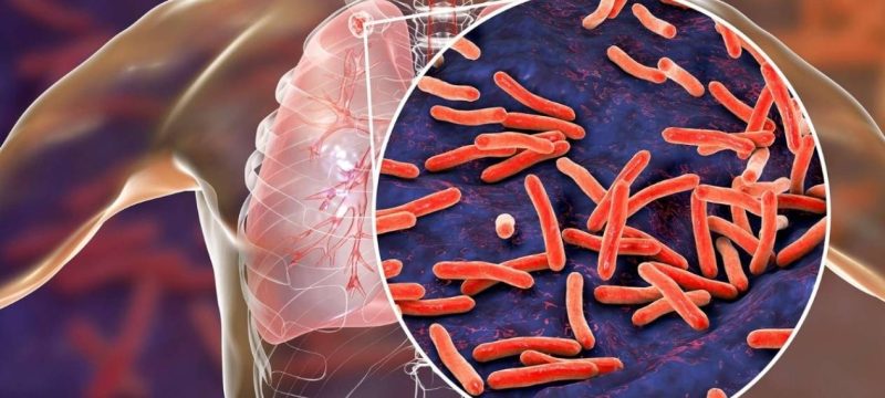 Rs. 1,100 Portable Device Can Detect TB Within 30 Minutes in Pakistan