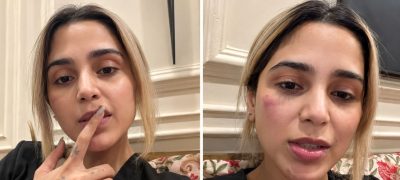 Aima Baig Breaks Silence After Facial Injury Sparks Concern