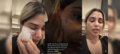 Aima Baig Reveals Painful Face Injury After Hitting Her Face on Door