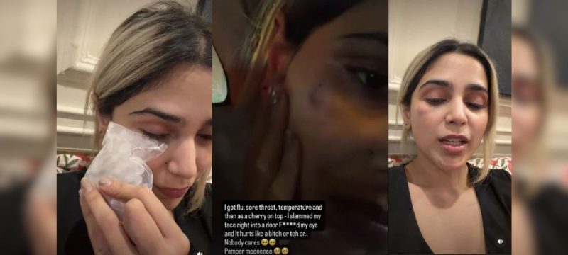 Aima Baig Reveals Painful Face Injury After Hitting Her Face on Door
